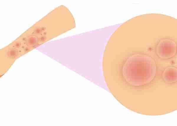 entrada blog dermatitis