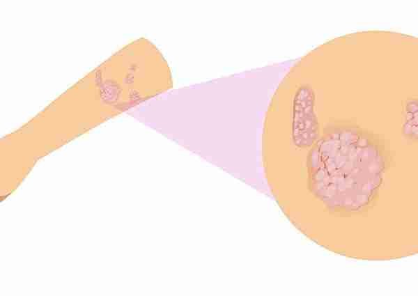 entrada blog psoriasis