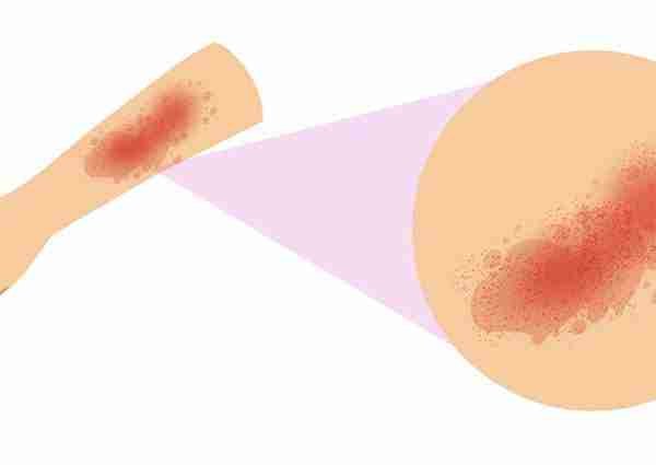 entrada blog urticaria