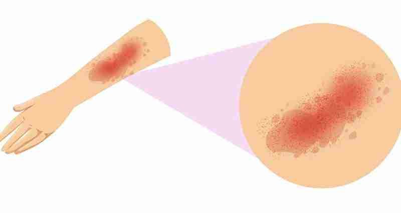 entrada blog urticaria