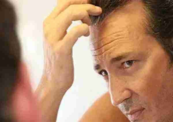 entrada blog alopecia